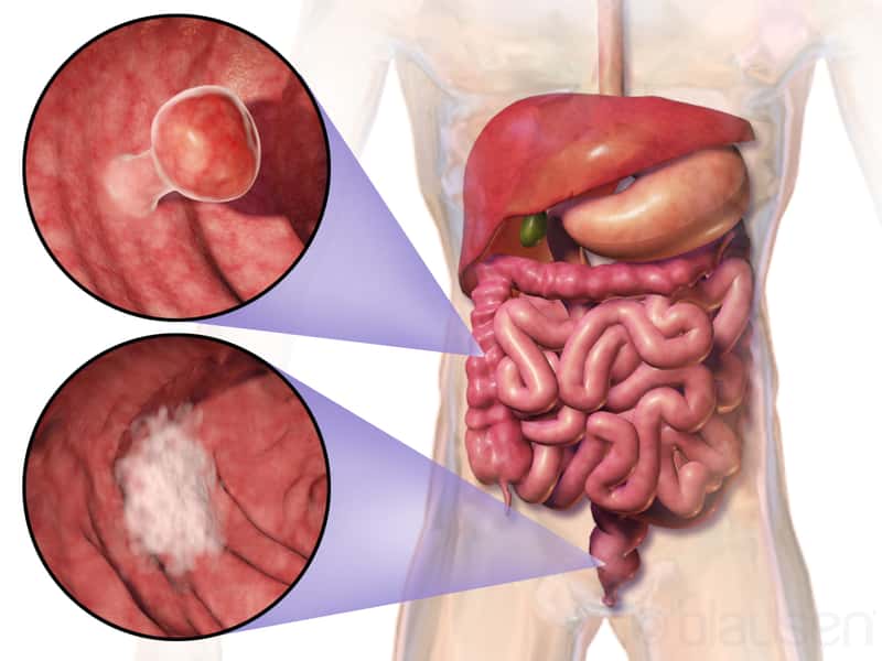 Le cancer colorectal peut se développer dans le côlon ou le rectum, qui font tous deux partie du gros intestin. © <em>Blausen Medical Communications</em>, Inc., <em>Wikimedia Commons</em>, cc by 3.0
