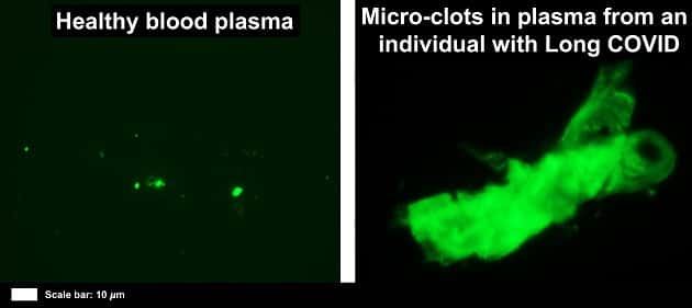 À gauche, un plasma sain. À droite, un microcaillot présent chez un individu atteint de Covid long. © Etheresia Pretorius et al., <em>Cardiovascular Diabetology</em> 