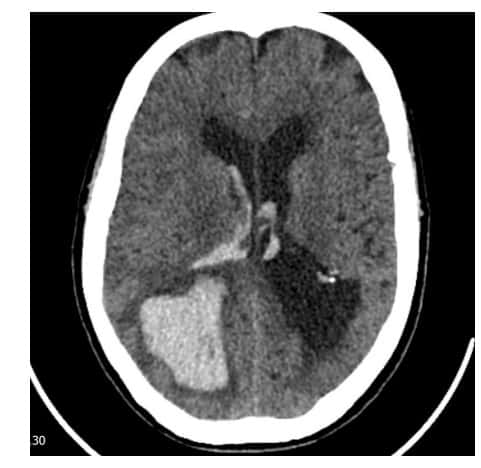 Le scanner cérébral de la patiente qui montre une hémorragie dans le lobe occipital droit. © Faisal Bashir Chaudhry et <em>al., BMJ</em>