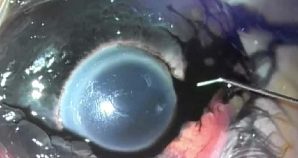 L'encre noire qui sort de l'œil du patient. © Paul R Freund, MD, Mark Greve MD