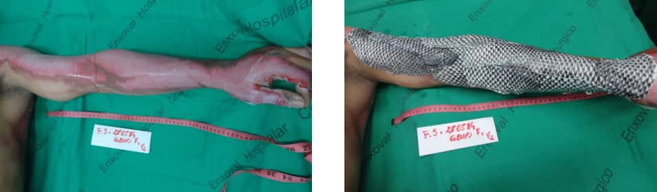 Les peaux de Tilapia appliquées sur le bras brûlé du patient au Brésil. © Edmar Maciel Lima-Junior et al., <em>Journal of Surgical Case Reports</em>