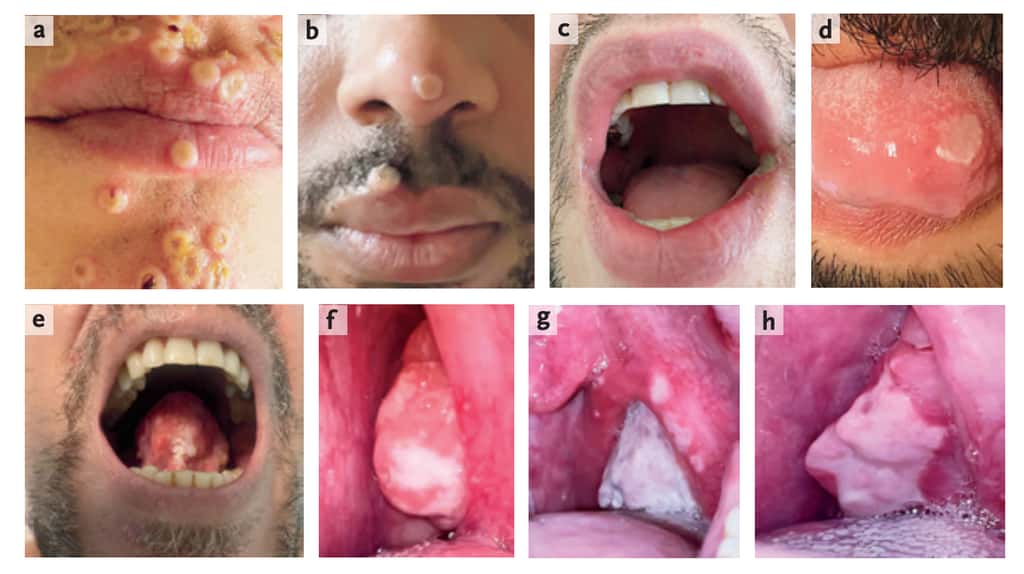 Exemples de lésions cutanées et mucosales sur le visage des personnes infectées par la variole du singe. © <em>The NEJM</em>