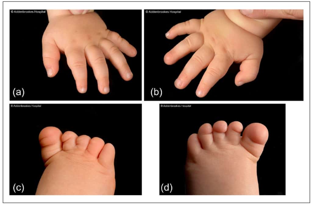L'anonychie présenté par le nourrisson. © <em>The Journal of Hand Surgery</em>