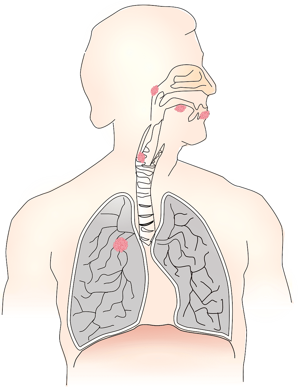 Le cancer de la gorge est appelé en médecine cancer des voies aérodigestives supérieures. © LUM3N by Pixabay