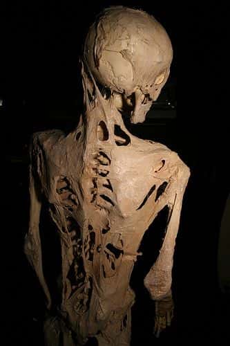 Le squelette d'une personne atteinte de la maladie. © Joh-co, CC by-sa 3.0