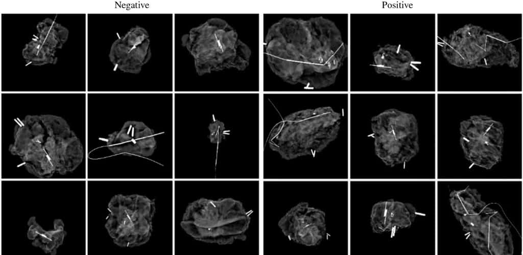 Exemples d'images de mammographies négatives et positives utilisées pour l'apprentissage du modèle d'IA. © Chen et <em>al</em>., UNC Health
