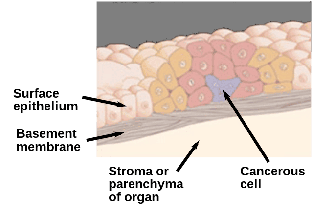  Cellule cancéreuse restant localisée dans l'épithélium© Jmarchn, Wikipedia Commons CC BY-SA 3.0