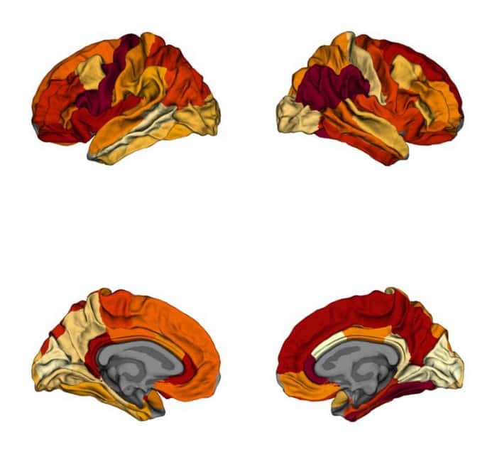 Les cartes cérébrales des différences entre l'épaisseur de la matière grise des patients obèses et atteints d'Alzheimer. Plus la couleur est foncée, plus les régions sont similaires. © Filip Morys