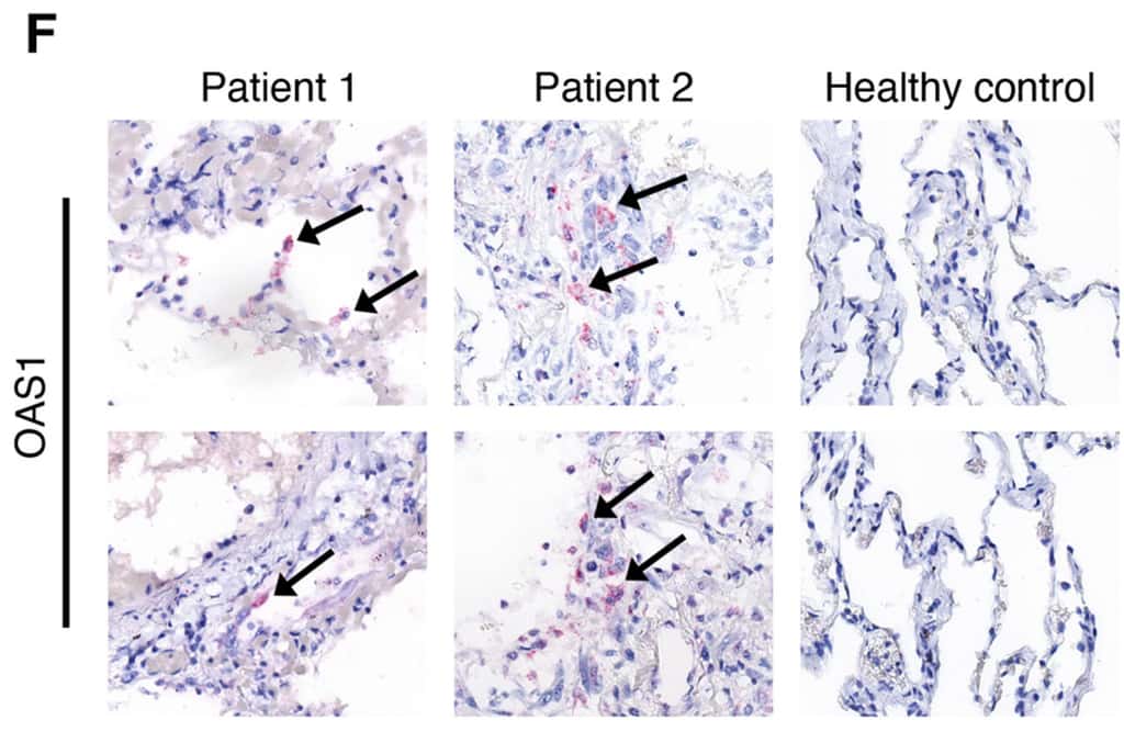 La présence du transcrit du gène OAS1 identifiée dans le tissu pulmonaire de deux patients décédés de la Covid-19. © Arthur Wickenhagen et al. Science