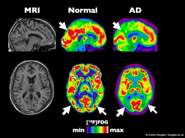 <em>Pet Scan</em> d’un cerveau en bonne santé et d’un cerveau atteint d’Alzheimer à un stade précoce. © Institut Douglas, flickr, cc by nc nd 2.0