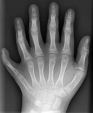 La polydactylie (un ou plusieurs doigts ou orteils supplémentaires est une anomalie congénitale © Drgnu23, Wilipedia commons, CC BY-SA 3.0