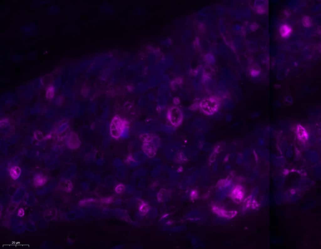 Des cellules fongiques (violet) observées dans les cellules cancéreuses (leur noyau en bleu). © Deborah Nejman et Nancy Gavert