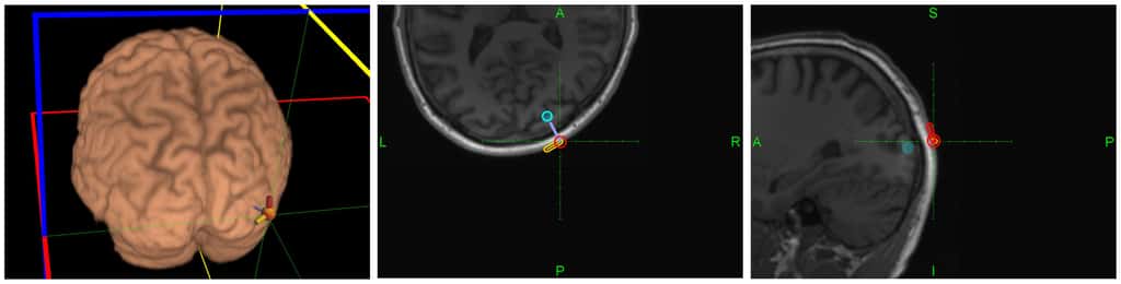 Localisation des stimulations sur le cerveau du receveur (à gauche). Les deux autres images montrent l'orientation du signal magnétique pour produire (en orange) ou ne pas produire (en rouge) l'illusion visuelle d'un phosphène. © 2014 Grau <em>et al.</em>