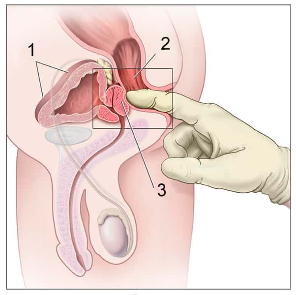 Schéma de toucher rectal (1) la vessie, (2) le rectum et (3) la prostate. © <em>Wikimédia</em>, CC by-sa 3.0