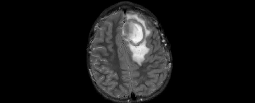  IRM d'un abcès cérébral rempli de pus chez un patient de 7 ans. © Sheehan et al., J. Neurosurg., 2008