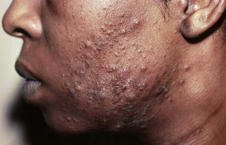 Un cas d'acné lié au masque. © Emily Rudd et Sarah Walsh, BMJ