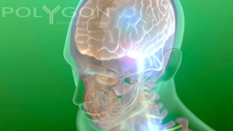 L’électronique injectée dans le cerveau permettrait d’enregistrer l'activité neurale. © Polygon Medical Animation, Flickr, CC by-nc-nd 2.0