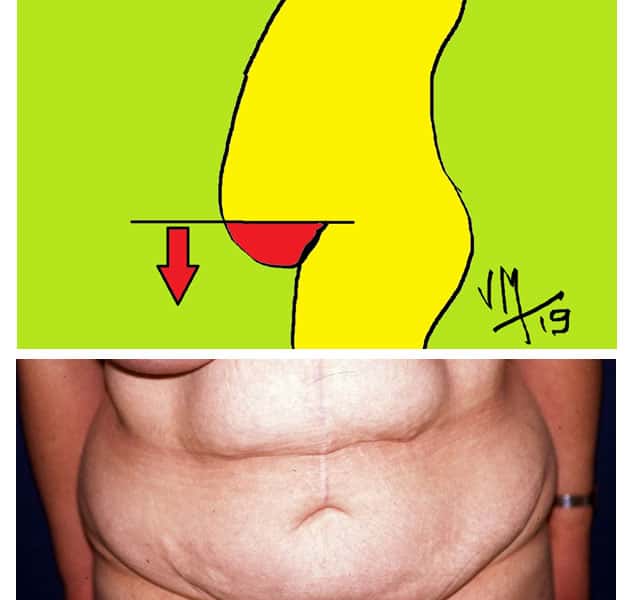 Un cas particulier : le ventre en besace ou tablier abdominal. © Dr Mitz, tous droits réservés