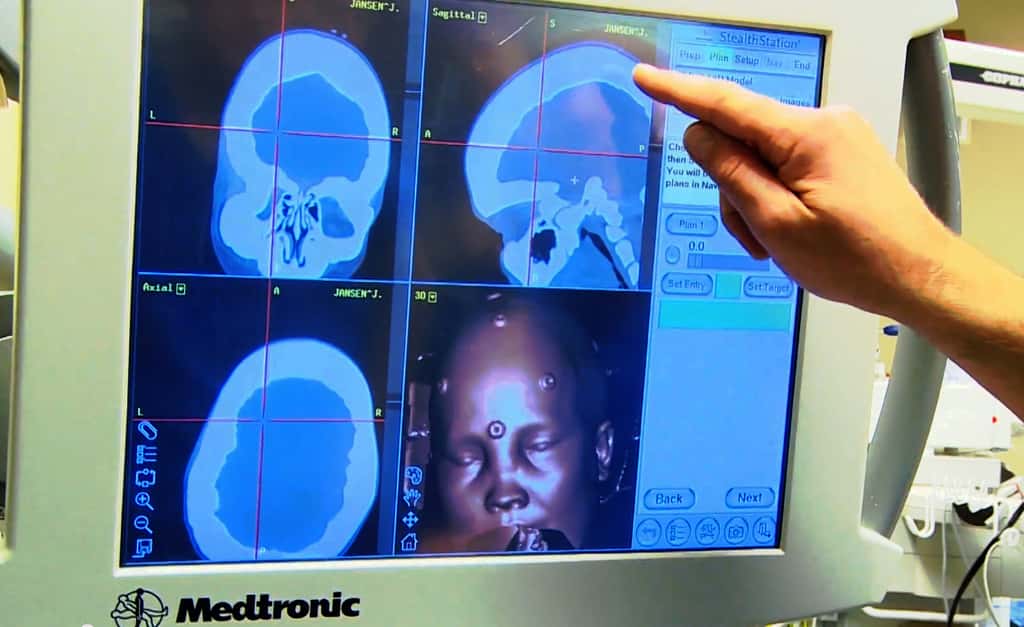 L’épaisseur du crâne biologique de la patiente, du fait de sa maladie osseuse chronique, atteignait 5 cm contre 1 cm en moyenne. © Centre universitaire médical d’Utrecht 
