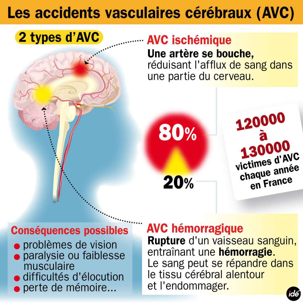 Il existe deux types d’accidents vasculaires cérébraux : l’AVC ischémique et l’AVC hémorragique. On en compte un toutes les quatre minutes en France. © Idé