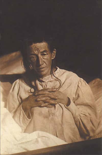 Auguste Deter, patiente du neurologue Aloïs Alzheimer, sur laquelle il décrivit la maladie neurodégénérative pour la première fois en 1906. © Wikimedia Commons, DP