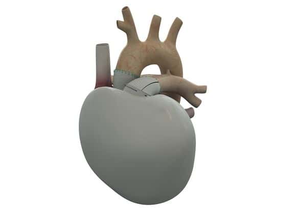 Le cœur artificiel de l'entreprise Carmat, relié aux oreillettes du patient, comporte deux ventricules qui assurent le mouvement du sang grâce à une pompe motorisée. Grâce à une analyse en temps réel, la puissance est régulée en fonction des besoins. © Carmat