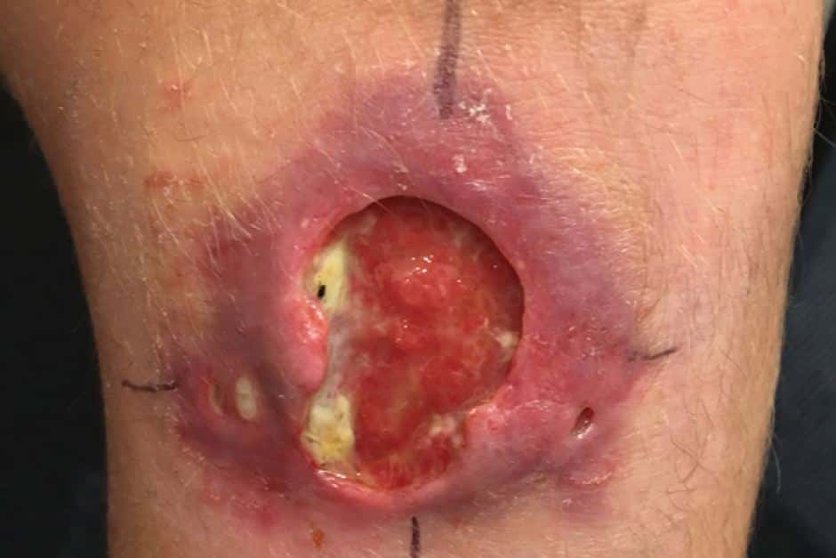 Une lésion au genou due à l’infection par <i>Mycobacterium ulcerans.</i> © Medical Journal of Australia
