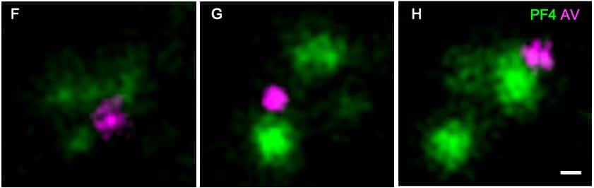 Les particules PF4 sécrétées par les thrombocytes (en vert) se lient avec l’adénovirus (rose) pour former des complexes qui peuvent déclencher une réaction auto-immune. © Andreas Greinacher et al., Research Square, 2021