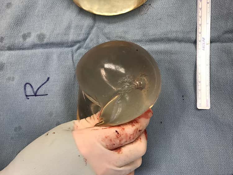 Les médecins ont procédé au retrait de l’implant mammaire, endommagé par la balle. © Giancarlo McEvenue et al, <em>Plastic Surgery Case Studies</em>, 2020