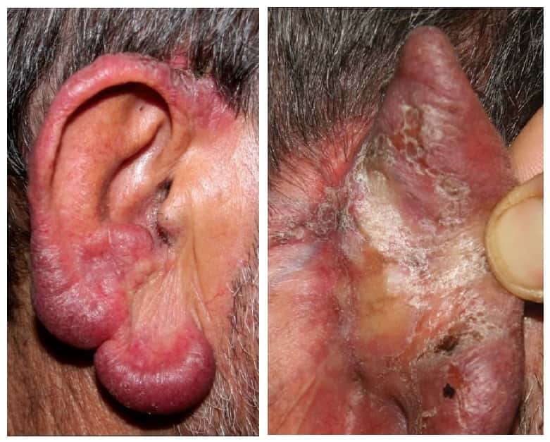 Un autre cas « d’oreille de dinde » dû à un lupus cutané tuberculeux. © Aslı Küçükünal et al, <em>Indian Journal of Dermatology</em>, 2012