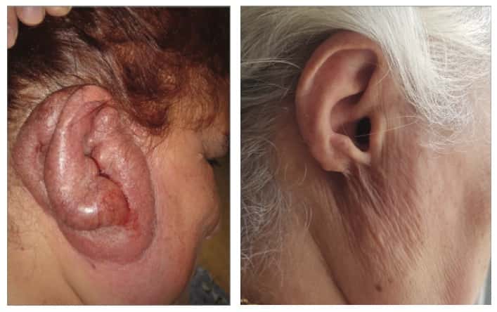 Lupus tuberculeux : l’oreille avant et après le traitement antibiotique. © Not Tsur et al, <em>JAMA Dermatology</em>, 2021