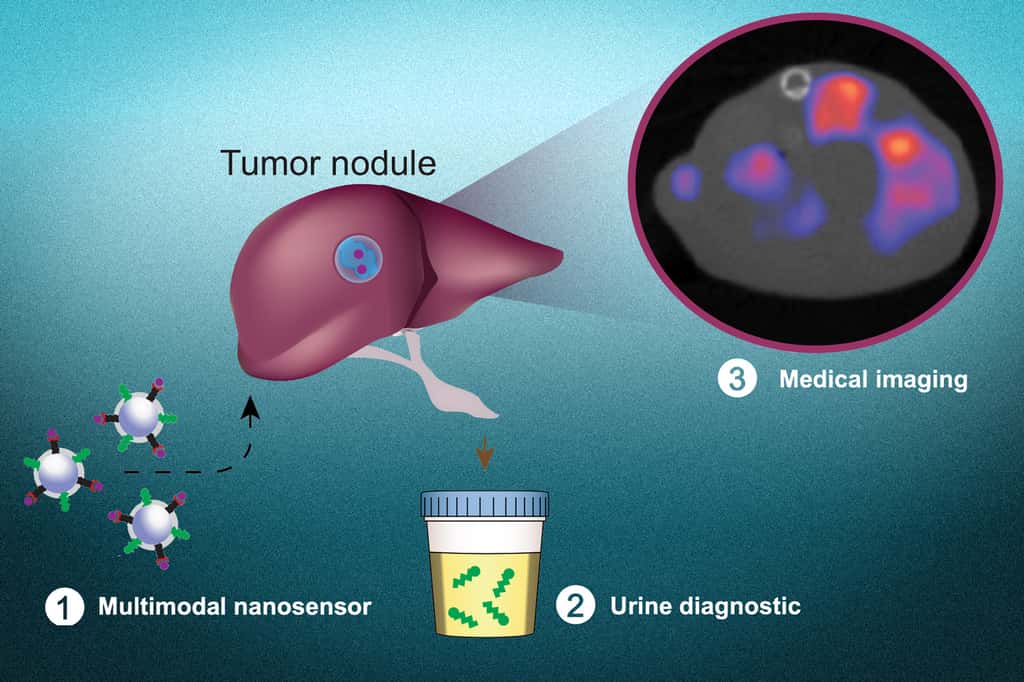 Les nanoparticules synthétiques servent à la fois à détecter les tumeurs dans l’urine et à les localiser à l’imagerie topographique. © Liangliang Hao