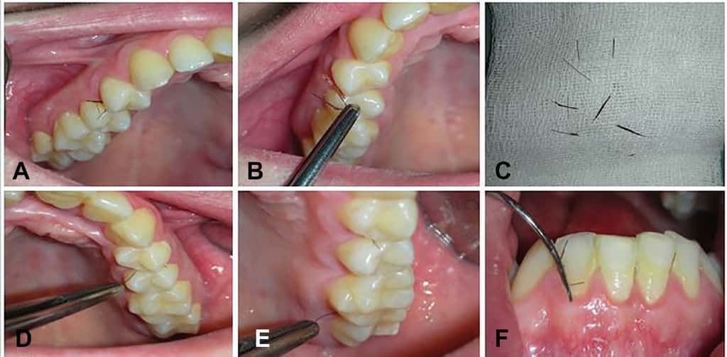 Plusieurs poils poussant entre les dents ont été retirés. © Khrystyna Zhurakivska et al, <em>Oral Surgery, Oral Medicine, Oral Pathology and Oral Radiology,</em> 2020