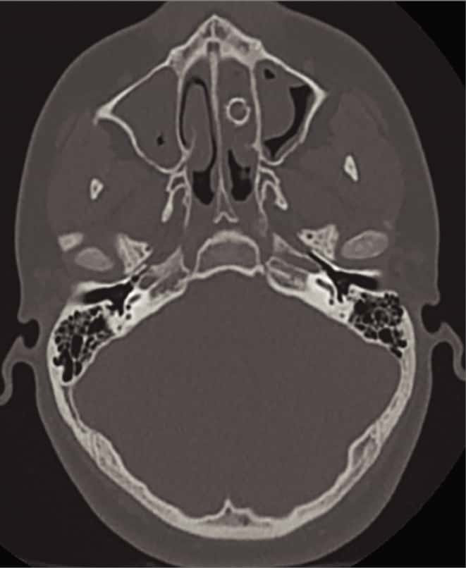 On distingue au scanner la balle de 9 mm logée dans la cavité nasale gauche. © Dylan Erwin et Marisa Earley, <em>JAMA Otolaryngol Head Neck Surg.,</em> 2021