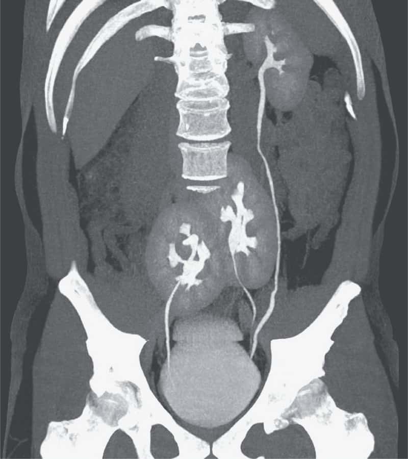 Le rein normal à gauche et les deux reins fusionnés situés dans le pelvis. © Jose O. Medina-Pestana et al, <em>The New England Journal of Medicine</em>, 2020