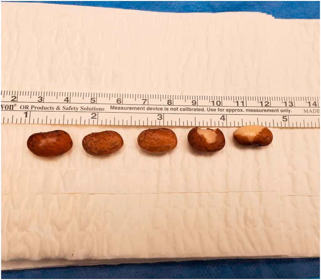 Six haricots rouges d’environ 15 mm de long et 7 mm de large ont pu être retirés. © Margeaux Dennis et al, <em>Urology Case Reports,</em> 2021