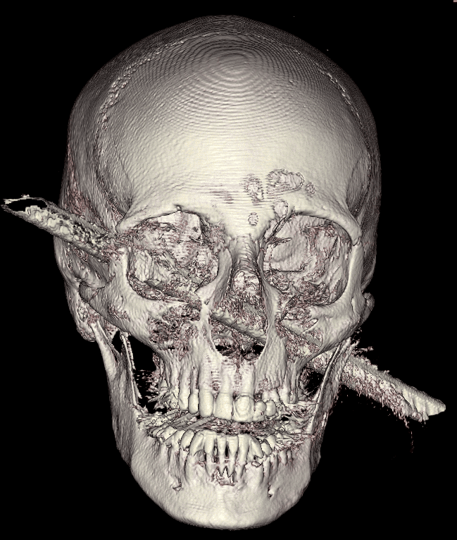 La tige en métal de 50 centimètres de long et un centimètre de diamètre traverse le crâne de part en part. © Samuel Moscovici