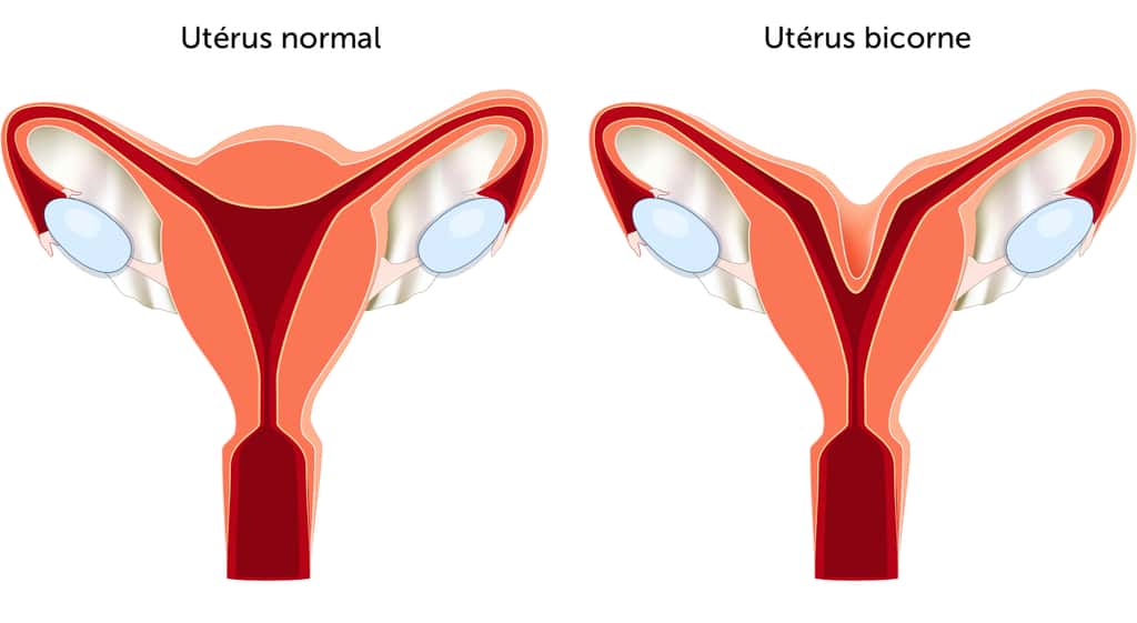 Un utérus bicorne se traduit par la présence de deux cavités utérines séparées. © designua, Adobe Stock