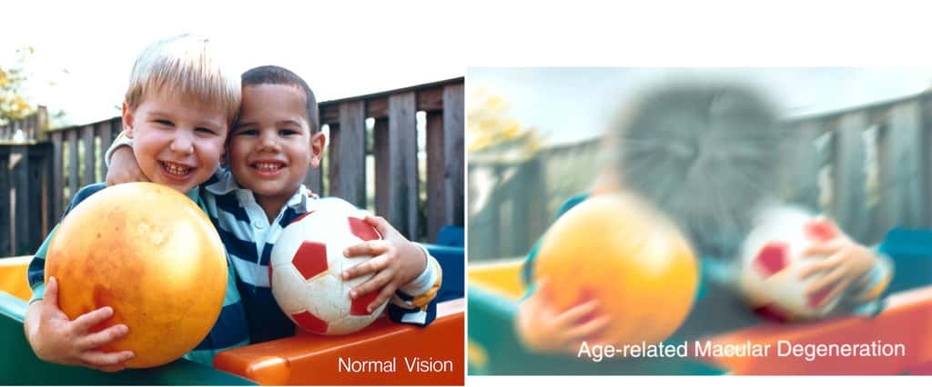 La dégénérescence maculaire liée à l'âge (DMLA) affecte grandement la vision. Le Centre national américain de l'œil propose la comparaison d'une même scène vue par une personne avec une vision normale (à gauche) et perçue par un patient atteint de DMLA (à droite). © <em>National Eye Institute</em>, DP