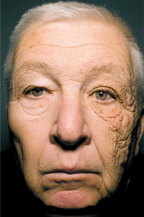William McElligot souffre très précisément de dermatohéliose, une maladie qui se caractérise par un vieillissement prématuré de la peau à cause des rayons du soleil. © Gordon et Brieva, New England Journal of Medicine