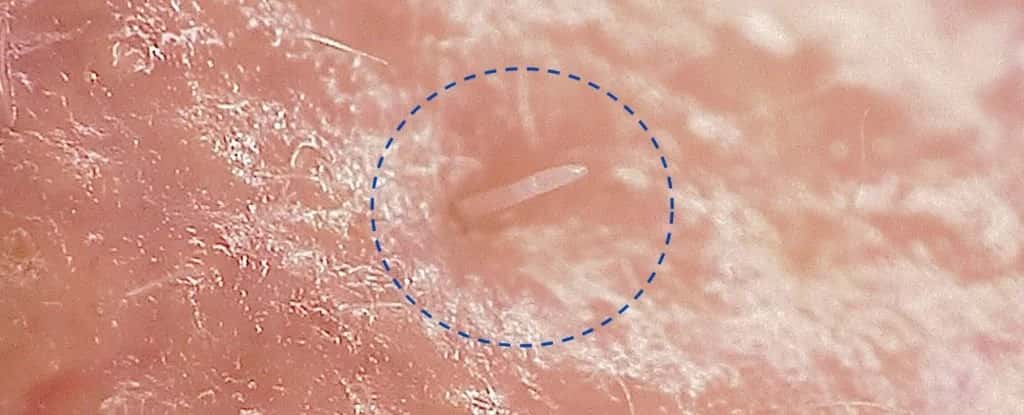 Une vue au microscope de <em>Demodex folliculorum</em>, la tête enfoncée dans un pore de notre peau. © Université de Reading