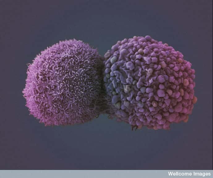 Les cellules cancéreuses peuvent apparaître bien des années après une infection virale. Le HPV est connu pour être à l'origine des cancers du col de l'utérus et dans certains cas de cancers de la gorge. © Anne Weston, Wellcome Images, Flickr, cc by nc nd 2.0