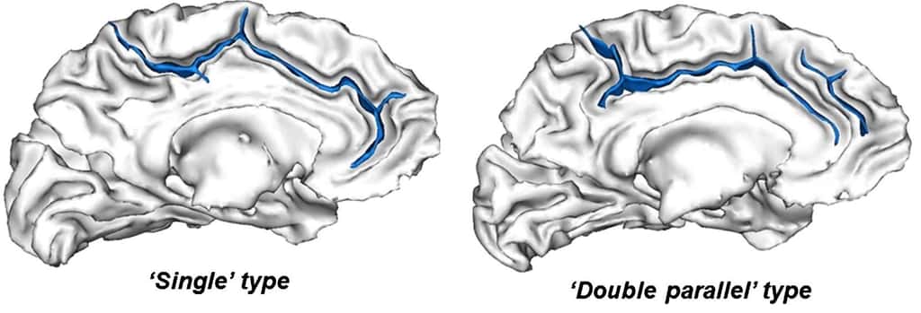 Voici les deux configurations que peuvent prendre le cortex cingulaire : un seul et unique sillon, comme à gauche, ou bien un sillon accompagné d’un deuxième, plus petit, situé en parallèle. © Arnaud Cachia <em>et al.</em>, <em>Journal of Cognitive Neuroscience</em>