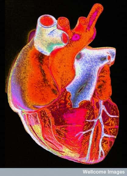Le stress peut provoquer une maladie au niveau des artères coronaires, les vaisseaux qui alimentent le cœur en sang. Dans ce cas, il peut déclencher une crise cardiaque. © <em>Gordon Museum</em>, <em>Wellcome Images</em>, Flickr, cc by nc nd 2.0