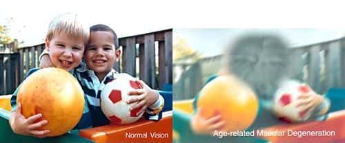 Comparaison entre vision normale et vision d’un sujet atteint de DMLA. Crédit : National Eye Institute, National Institutes of Health
