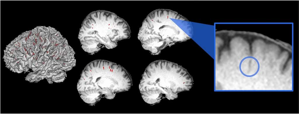 Ici, les espaces périvasculaires identifiés dans le cerveau d’un astronaute avant son départ pour l’espace. En rouge, ces espaces superposés sur la matière blanche de l’individu (à gauche) ainsi que sur plusieurs tranches de son scan structurel (à droite). Dans l’encadré bleu, l’agrandissement d’un espace périvasculaire. © Kathleen E. Hupfeld et <em>al.</em>, <em>Scientific Reports</em>