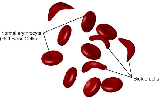 Les personnes atteintes de drépanocytose (ou anémie falciforme) ont des globules rouges en forme de faucille (<em>sickle cells</em> ici). Ce changement de morphologie peut être détecté grâce à un microscope photoacoustique. © <em>National Human Genome Research Institute</em>, DP