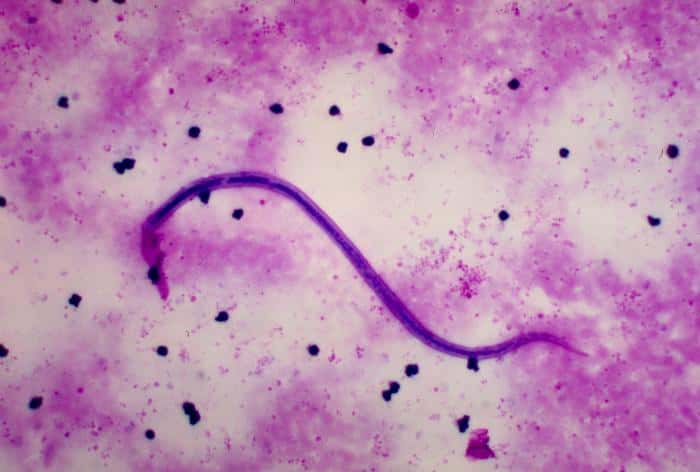 Le ver filaire <em>Wuchereria bancrofti</em> est le parasite à l'origine de la filariose de Bancroft, ou éléphantiasis. Il s'infiltre dans le système lymphatique et occasionne un gonflement des tissus impressionnant déformant les organes des malades. Il peut mesurer jusqu'à 10 cm de long. © Prep4md, Flickr, cc by 2.0