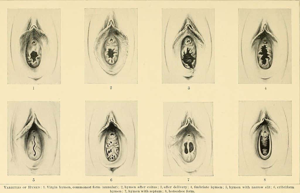 La rupture ou l’ouverture naturelle de l’hymen est multifactorielle © Wikimedia Commons, Norris Richard C., DP