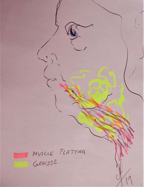 La répartition de graisse en jaune et du muscle platysma en violet. © Dr Mitz, tous droits réservés